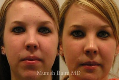 Facial Implant Augmentation Before & After Gallery - Patient 382736 - Image 1