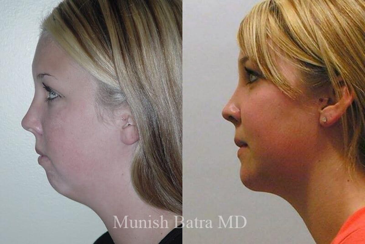 Facial Implant Augmentation Before & After Gallery - Patient 382736 - Image 2