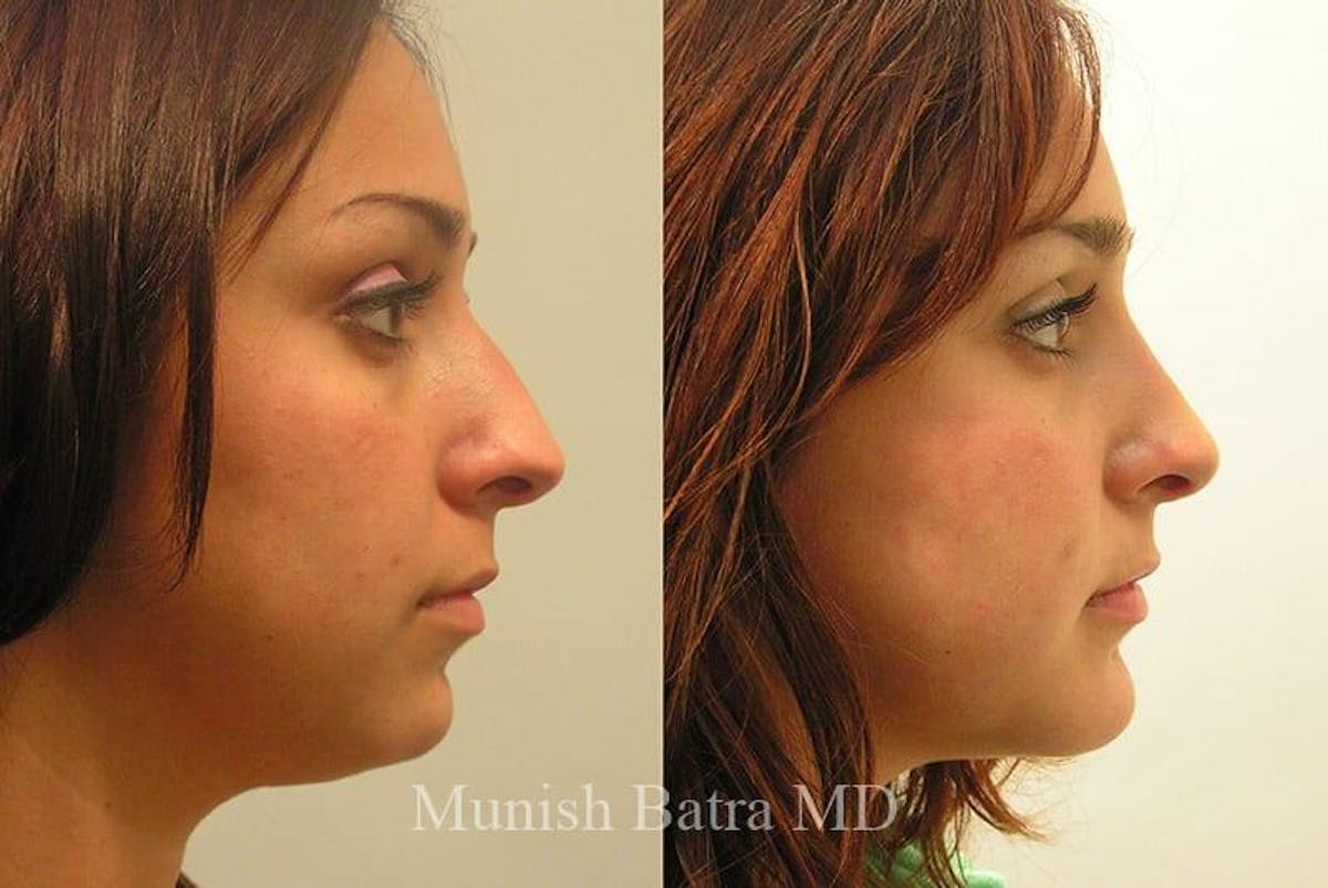 Facial Implant Augmentation Before & After Gallery - Patient 178267 - Image 1