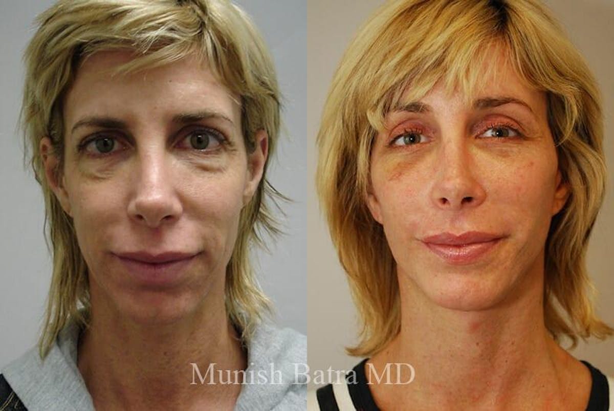 Facial Implant Augmentation Before & After Gallery - Patient 395650 - Image 1