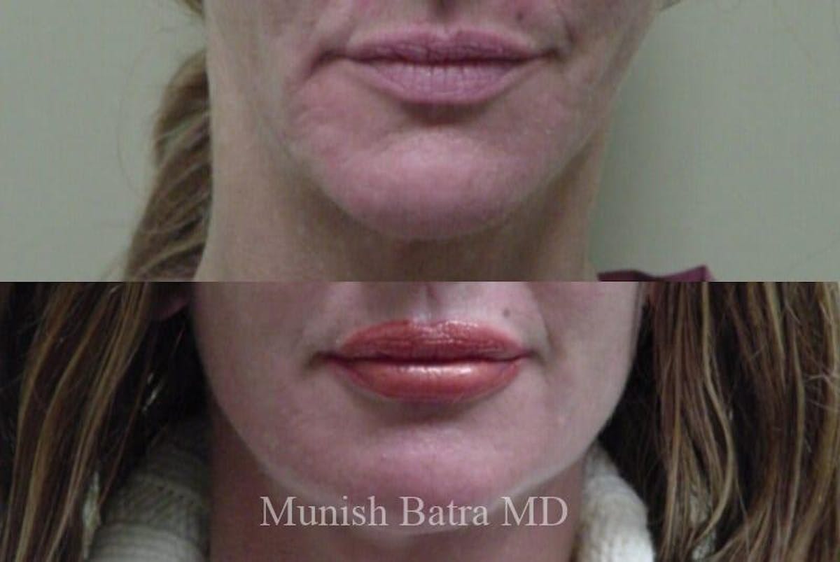 Facial Implant Augmentation Before & After Gallery - Patient 414454 - Image 1