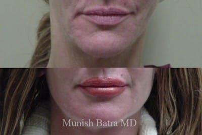 Facial Implant Augmentation Before & After Gallery - Patient 414454 - Image 1