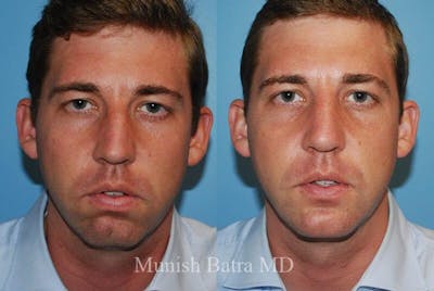 Facial Implant Augmentation Before & After Gallery - Patient 309390 - Image 1