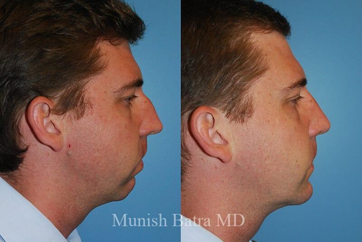 Facial Implant Augmentation Before & After Gallery - Patient 309390 - Image 2