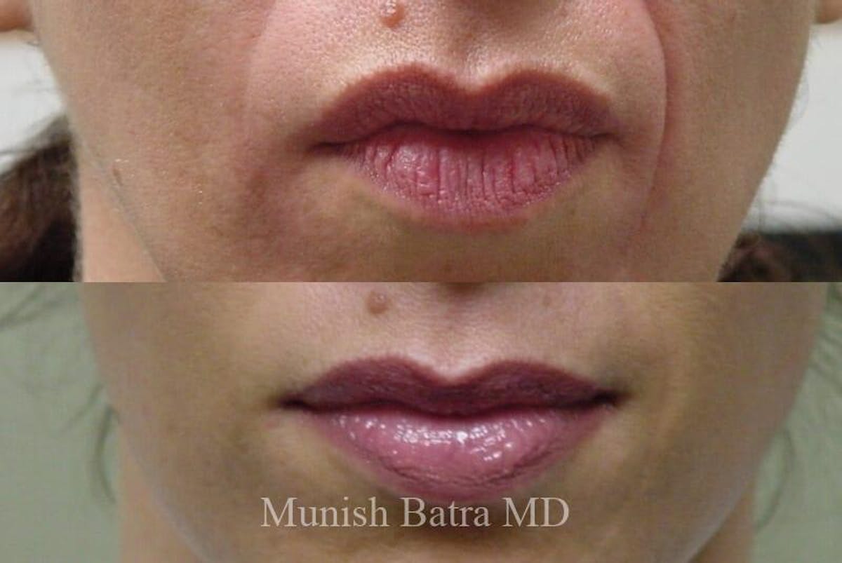 Fillers and BOTOX® Before & After Gallery - Patient 351019 - Image 1