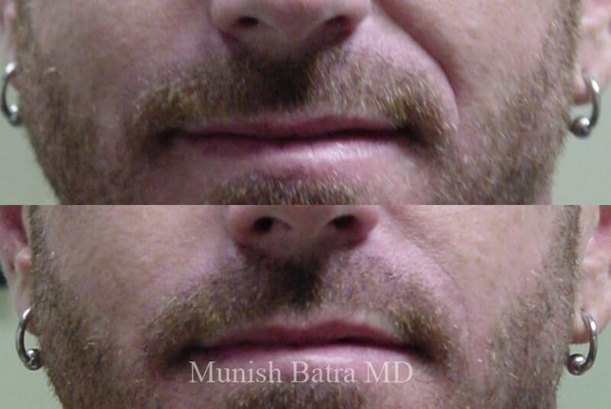 Fillers and BOTOX® Before & After Gallery - Patient 326672 - Image 1
