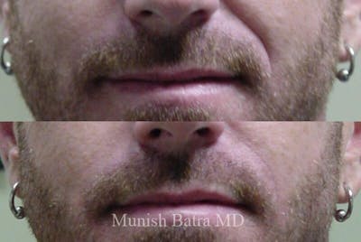 Fillers and BOTOX® Before & After Gallery - Patient 326672 - Image 1