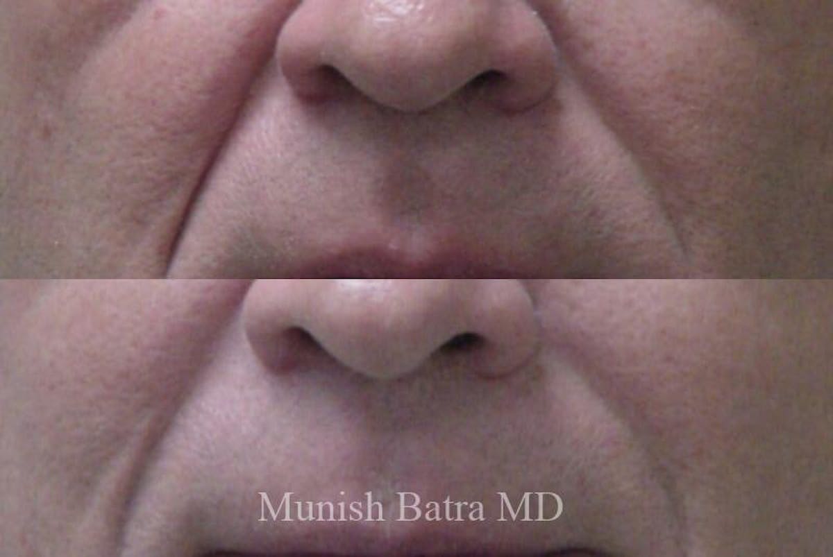 Fillers and BOTOX® Before & After Gallery - Patient 251516 - Image 1