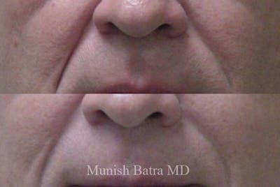 Fillers and BOTOX® Before & After Gallery - Patient 251516 - Image 1