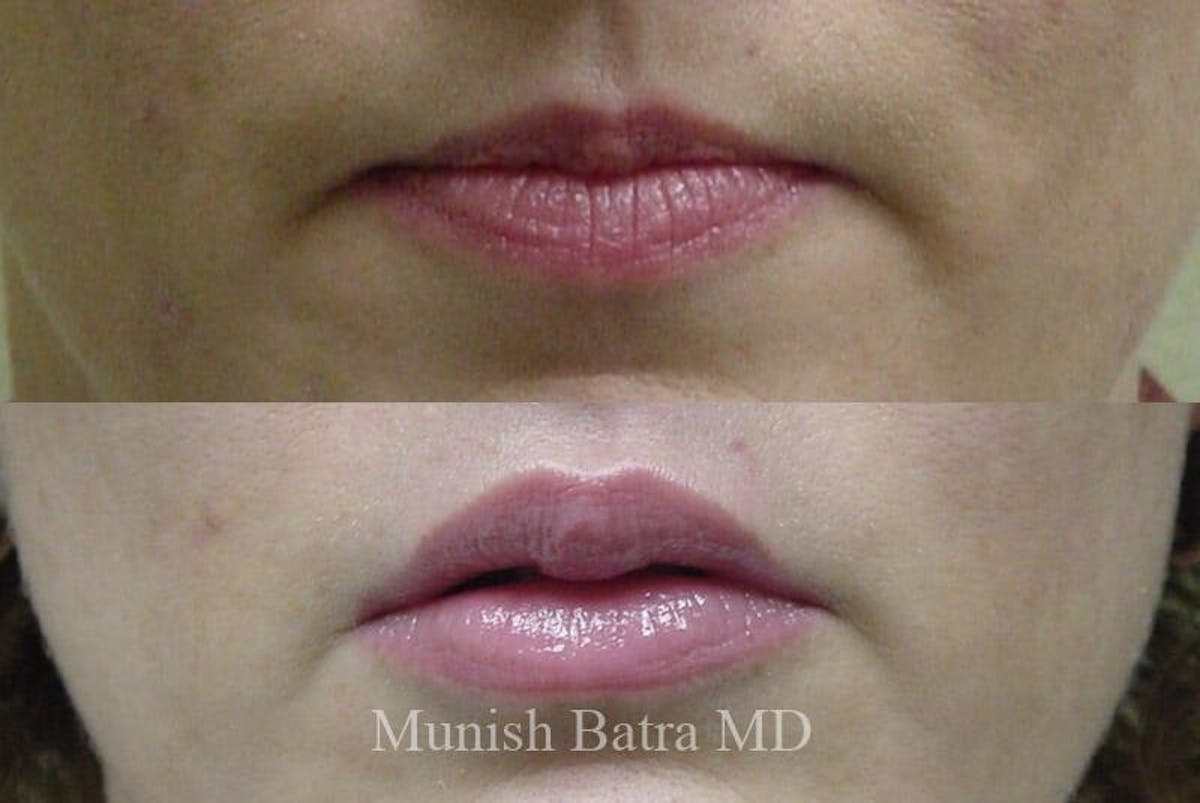 Fillers and BOTOX® Before & After Gallery - Patient 982822 - Image 1