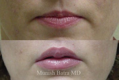 Fillers and BOTOX® Before & After Gallery - Patient 982822 - Image 1