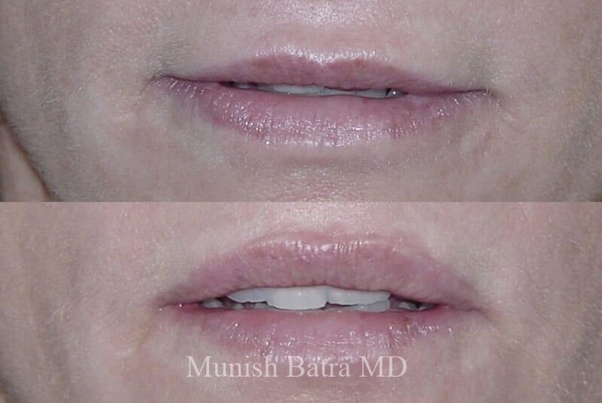 Fillers and BOTOX® Before & After Gallery - Patient 367617 - Image 1