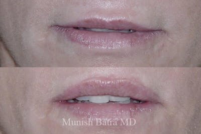 Fillers and BOTOX® Before & After Gallery - Patient 367617 - Image 1