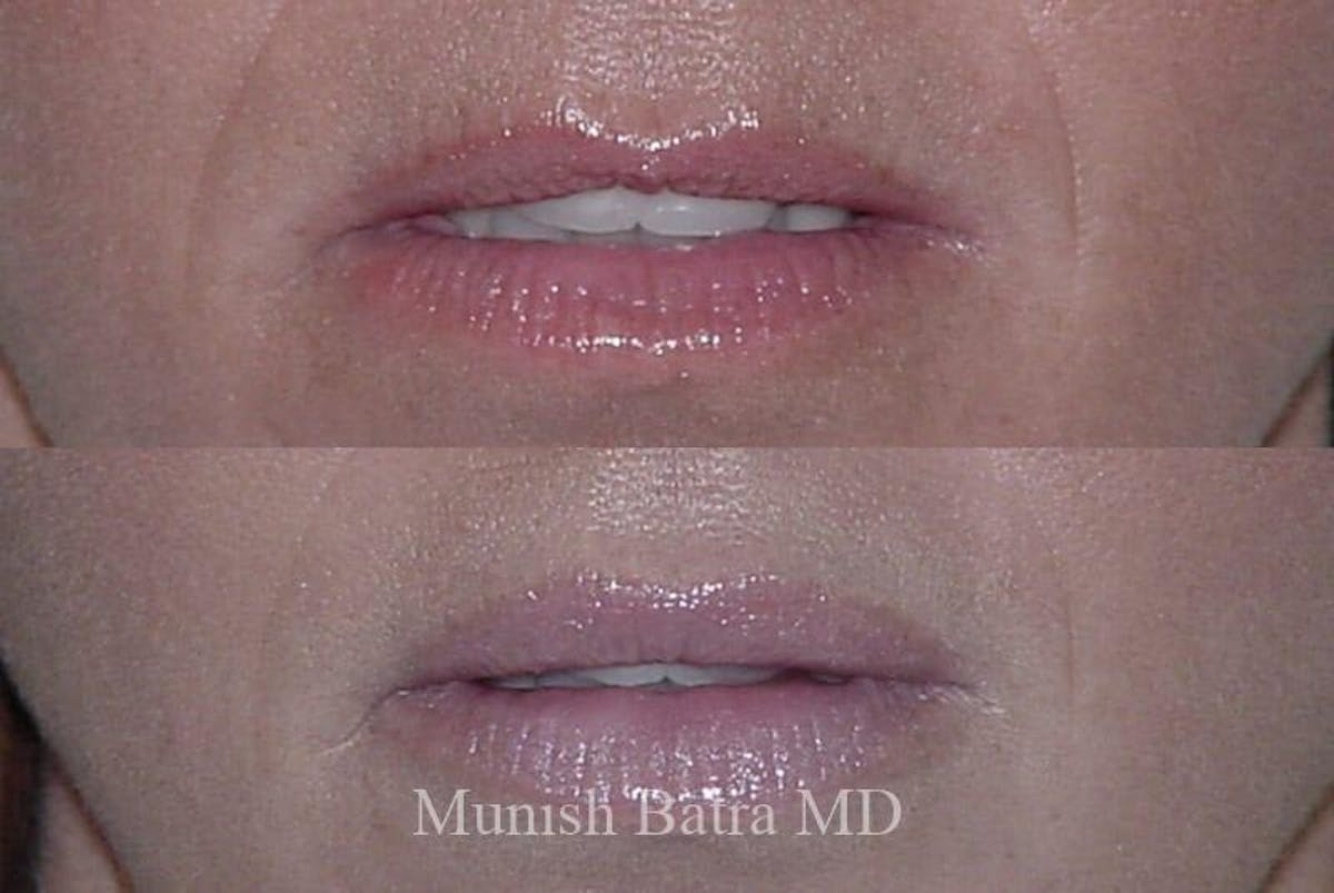 Fillers and BOTOX® Before & After Gallery - Patient 107468 - Image 1