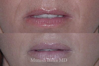 Fillers and BOTOX® Before & After Gallery - Patient 107468 - Image 1