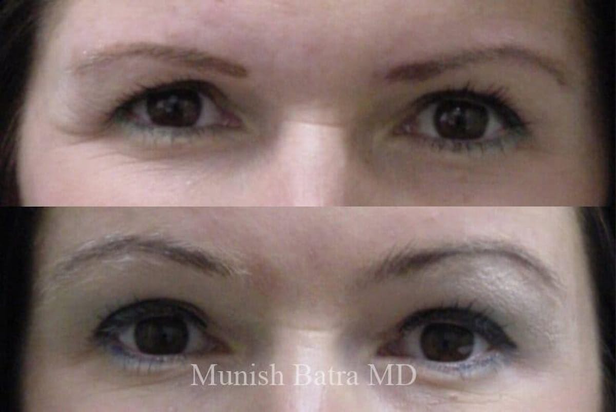 Fillers and BOTOX® Before & After Gallery - Patient 278697 - Image 1