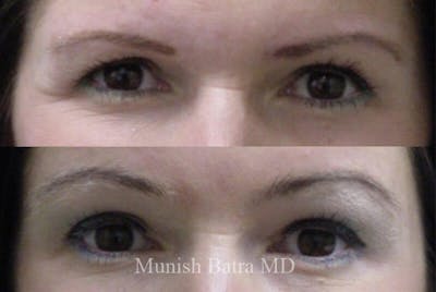 Fillers and BOTOX® Before & After Gallery - Patient 278697 - Image 1