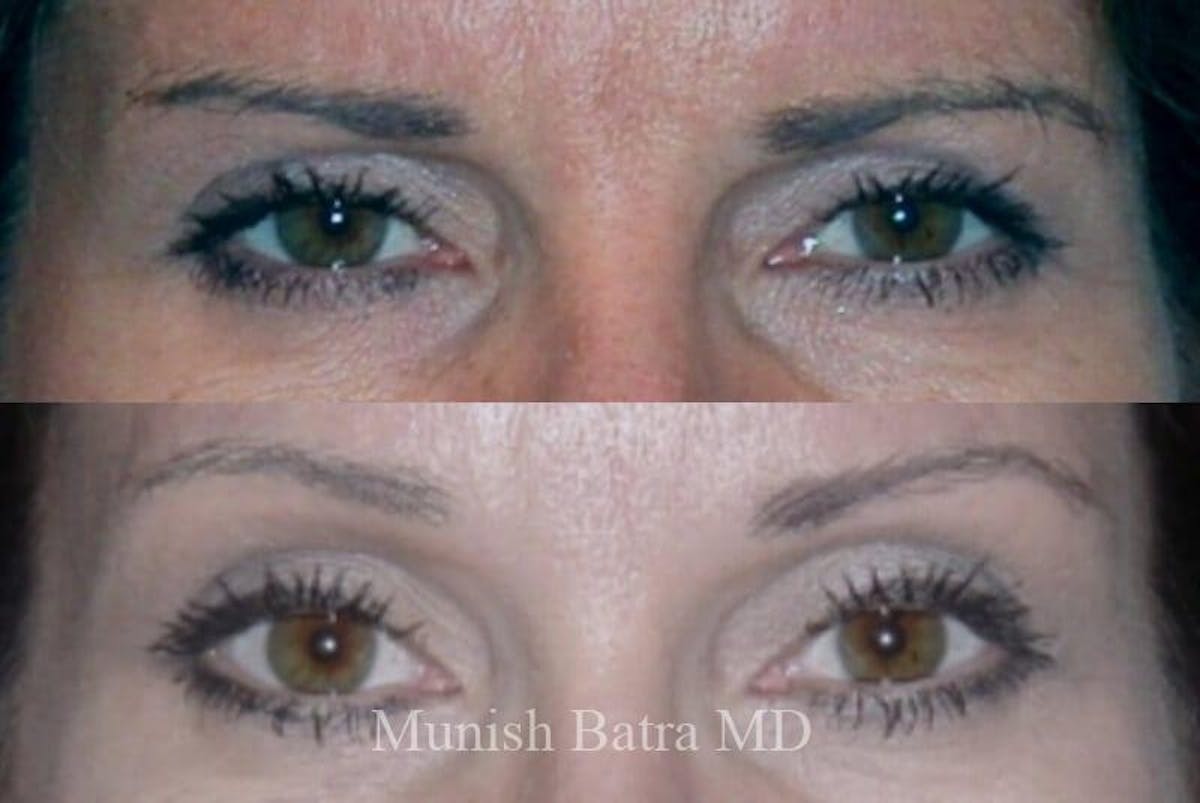 Fillers and BOTOX® Before & After Gallery - Patient 122324 - Image 1