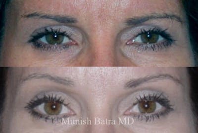 Fillers and BOTOX® Before & After Gallery - Patient 122324 - Image 1