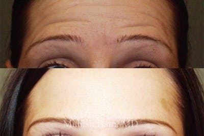 Fillers and BOTOX® Before & After Gallery - Patient 122730 - Image 1
