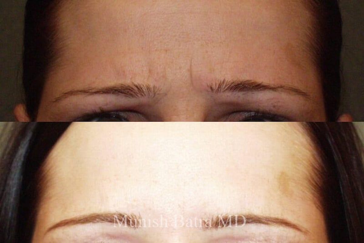 Fillers and BOTOX® Before & After Gallery - Patient 122730 - Image 2