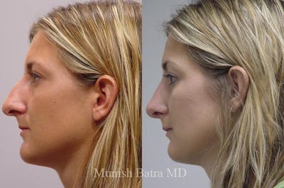 Rhinoplasty Before & After Gallery - Patient 189822 - Image 1
