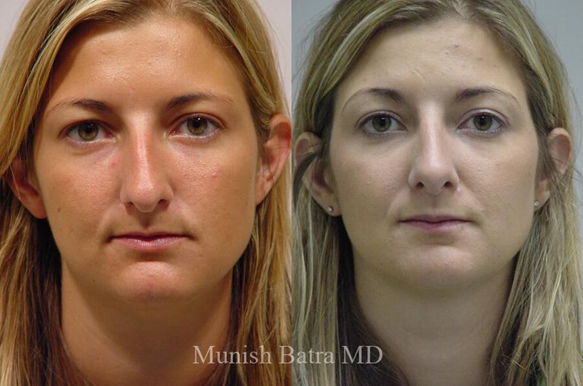 Rhinoplasty Before & After Gallery - Patient 189822 - Image 2