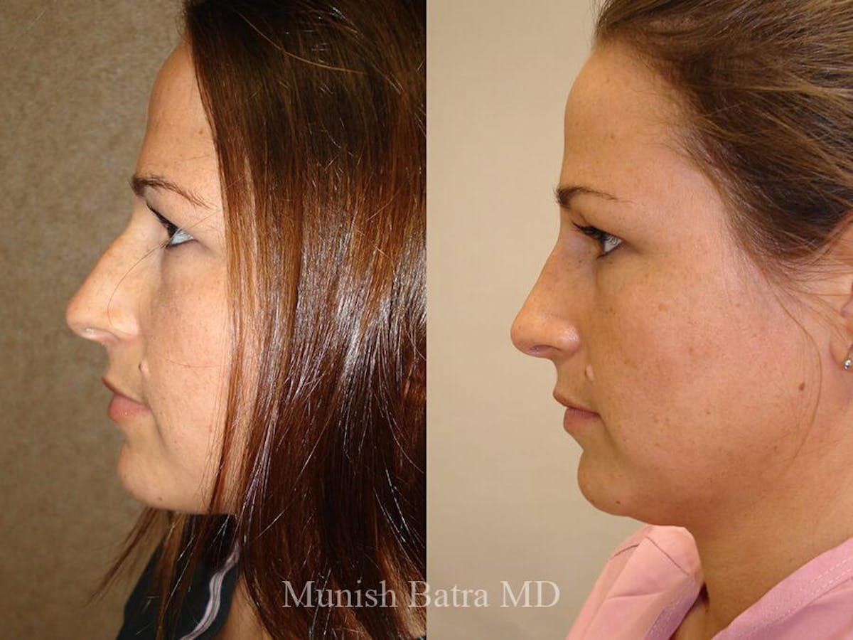 Rhinoplasty Before & After Gallery - Patient 108811 - Image 1