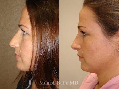 Rhinoplasty Before & After Gallery - Patient 108811 - Image 1