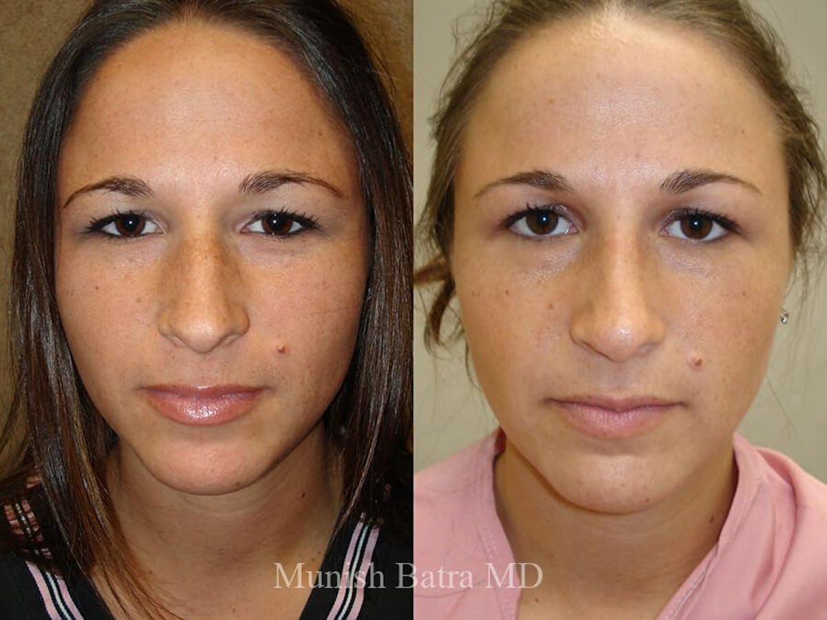 Rhinoplasty Before & After Gallery - Patient 108811 - Image 2