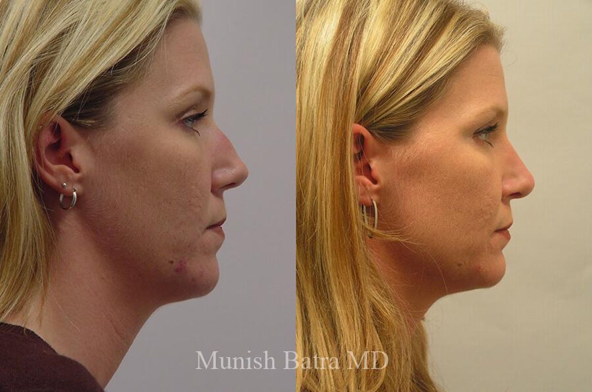 Rhinoplasty Before & After Gallery - Patient 658823 - Image 1