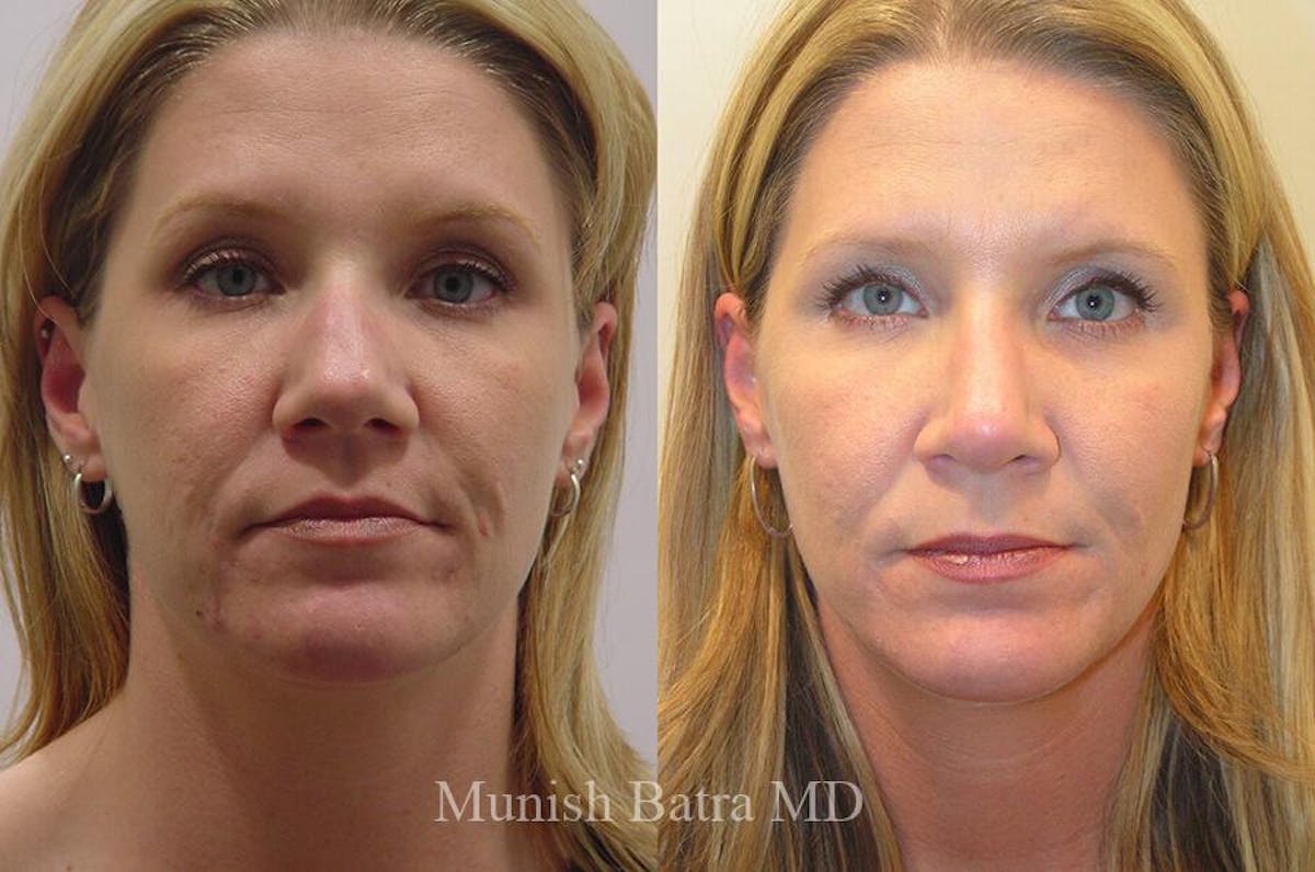 Rhinoplasty Before & After Gallery - Patient 658823 - Image 2