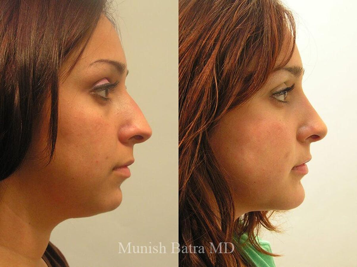 Rhinoplasty Before & After Gallery - Patient 332965 - Image 1
