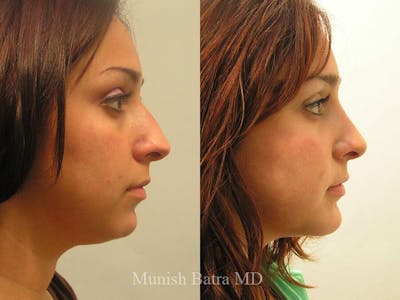 Rhinoplasty Before & After Gallery - Patient 332965 - Image 1