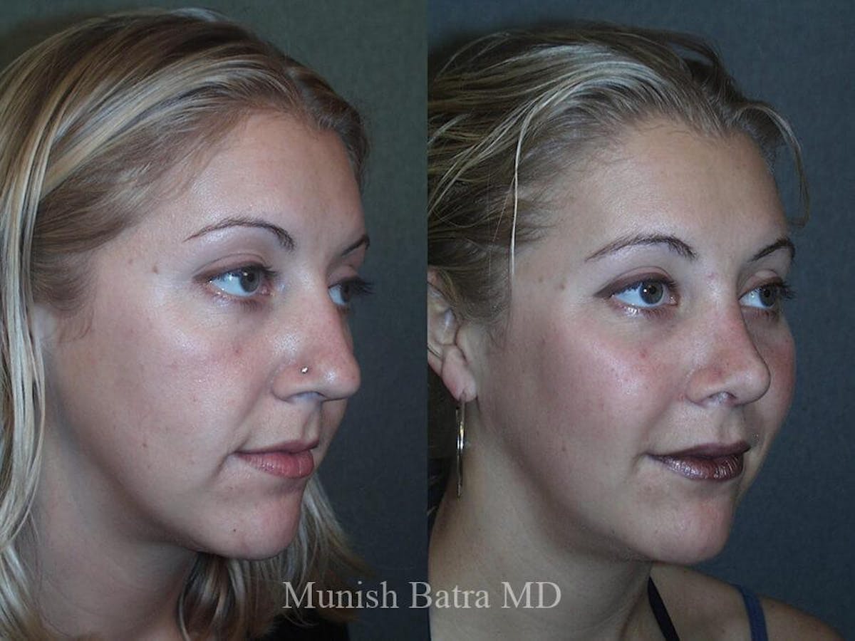 Rhinoplasty Before & After Gallery - Patient 673671 - Image 1