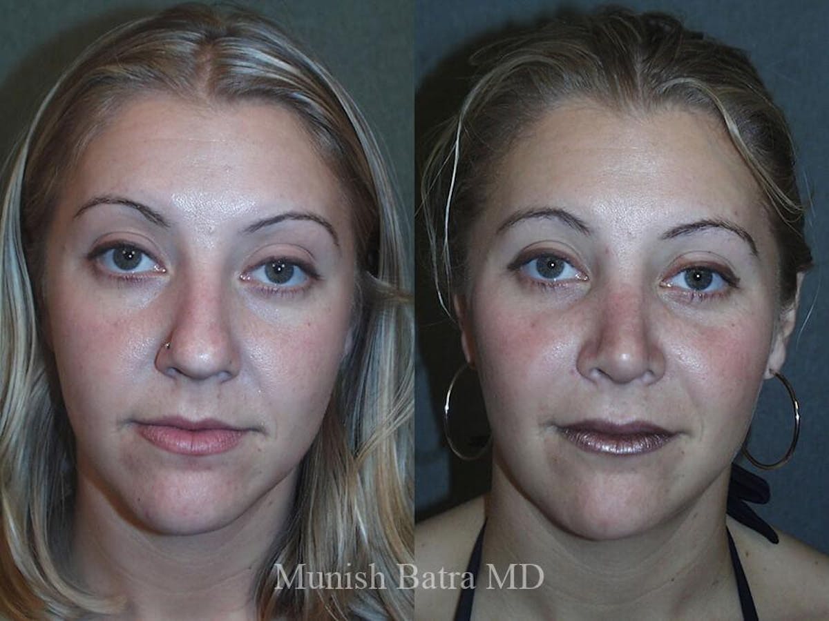 Rhinoplasty Before & After Gallery - Patient 673671 - Image 2