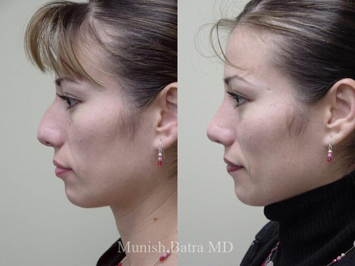 Rhinoplasty Before & After Gallery - Patient 407372 - Image 1