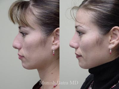Rhinoplasty Before & After Gallery - Patient 407372 - Image 1