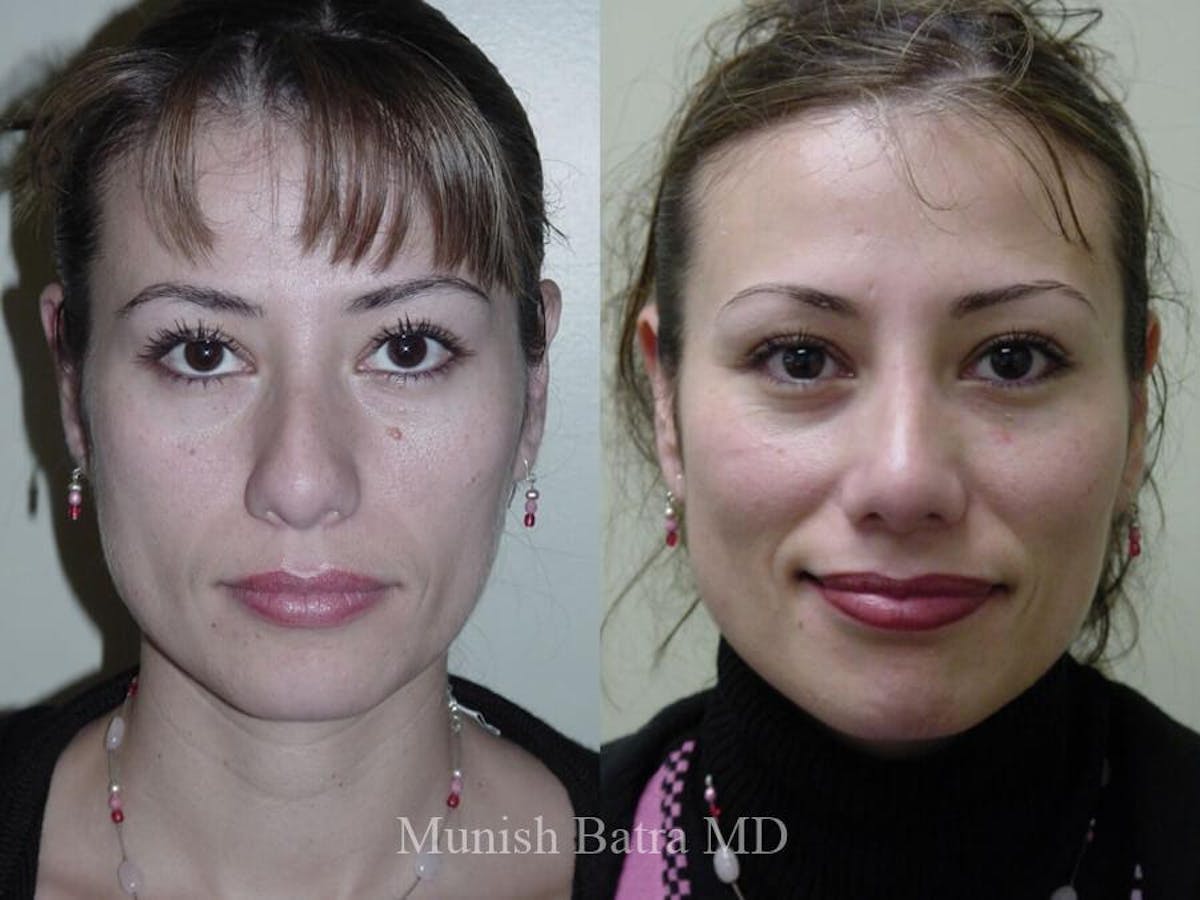Rhinoplasty Before & After Gallery - Patient 407372 - Image 2