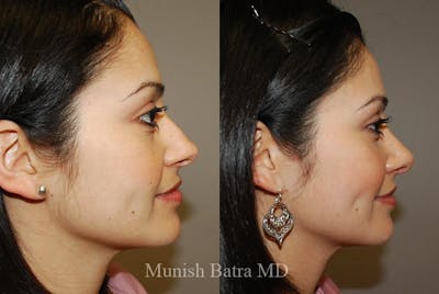 Rhinoplasty Before & After Gallery - Patient 389223 - Image 1