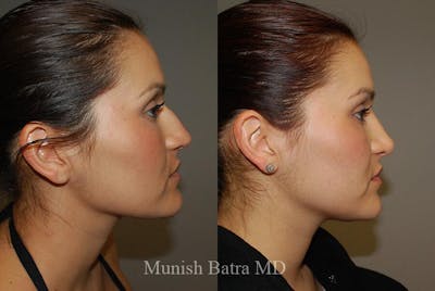Rhinoplasty Before & After Gallery - Patient 728508 - Image 1