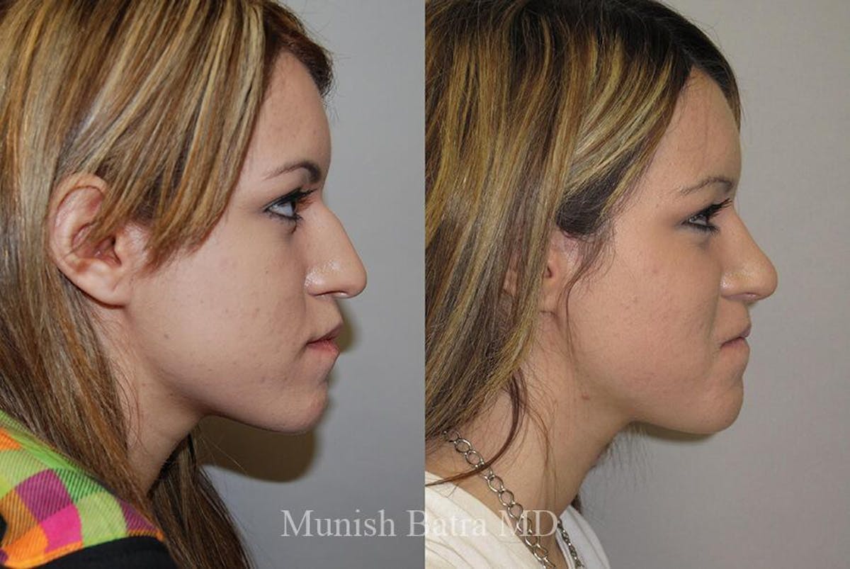 Rhinoplasty Before & After Gallery - Patient 358252 - Image 1