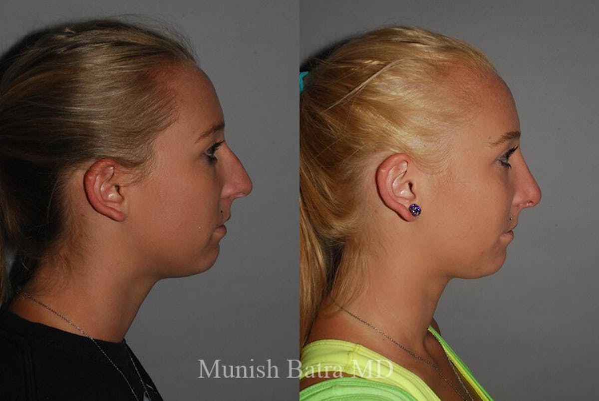 Rhinoplasty Before & After Gallery - Patient 361490 - Image 1