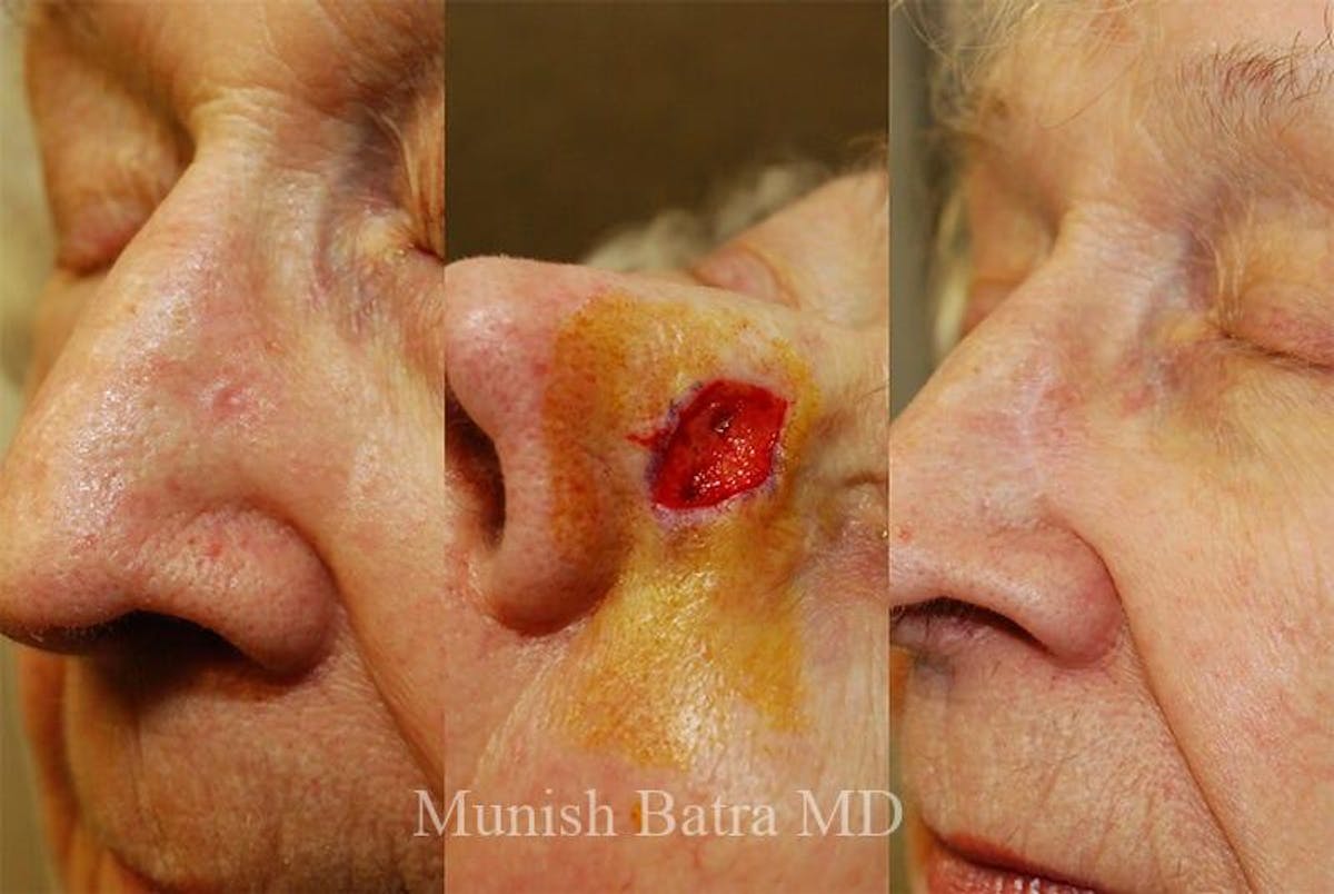 Skin Cancer Before & After Gallery - Patient 192480 - Image 1