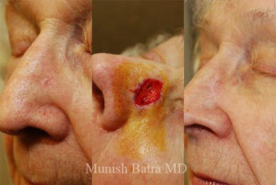Skin Cancer Before & After Gallery - Patient 192480 - Image 1