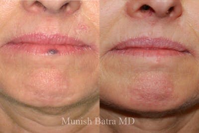 Skin Cancer Before & After Gallery - Patient 808189 - Image 1