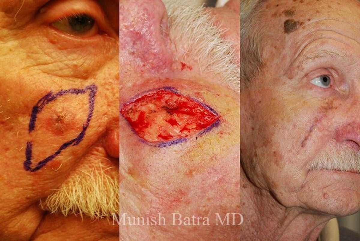 Skin Cancer Before & After Gallery - Patient 151803 - Image 1