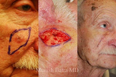 Skin Cancer Before & After Gallery - Patient 151803 - Image 1