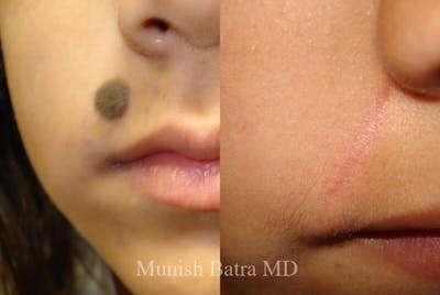 Skin Cancer Before & After Gallery - Patient 417327 - Image 1