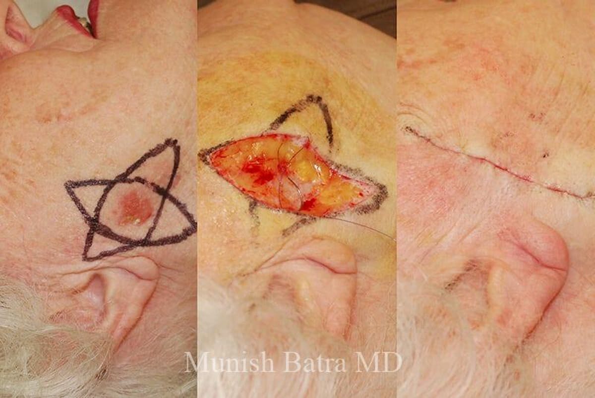 Skin Cancer Before & After Gallery - Patient 183731 - Image 1